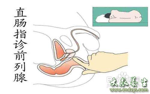 前列腺自我按摩手法