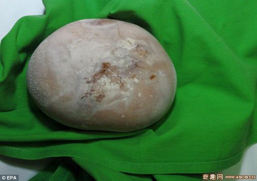 [图文]恐怖!匈牙利医生从患者体内取出椰子大肾结石